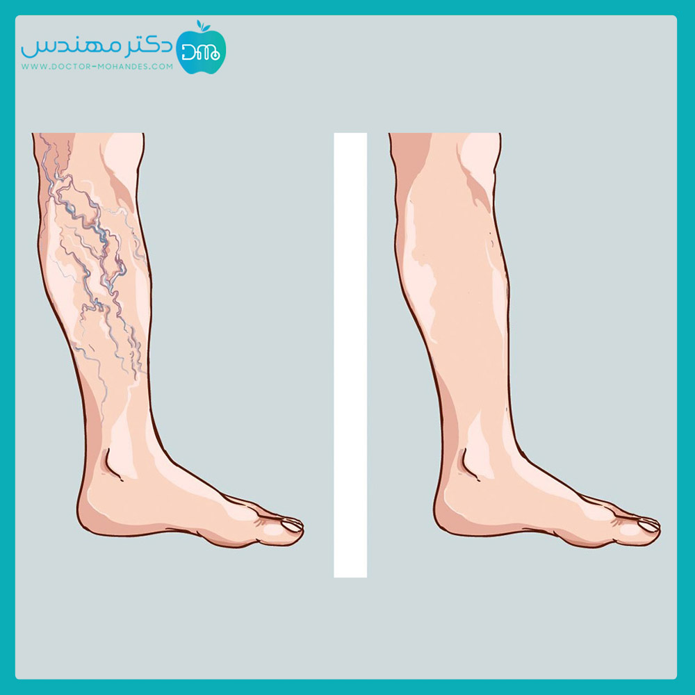 واریس-پا-چیست.jpg