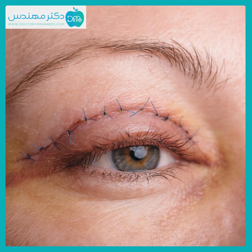 جراحی پلک