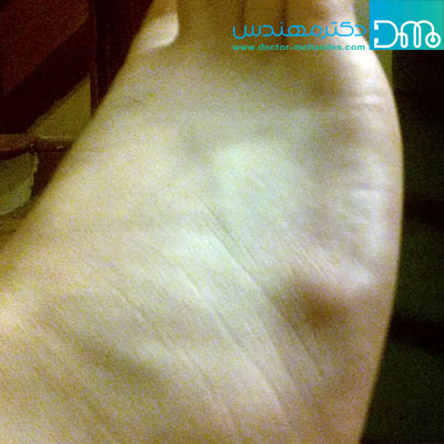 Ganglion cyst