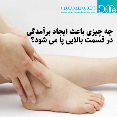 چه چیزی باعث ایجاد برآمدگی در قسمت بالایی پا می شود؟