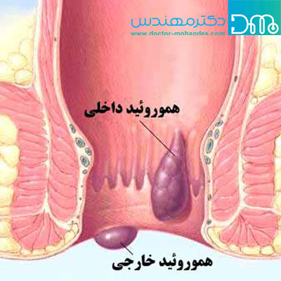 انواع بواسیر 