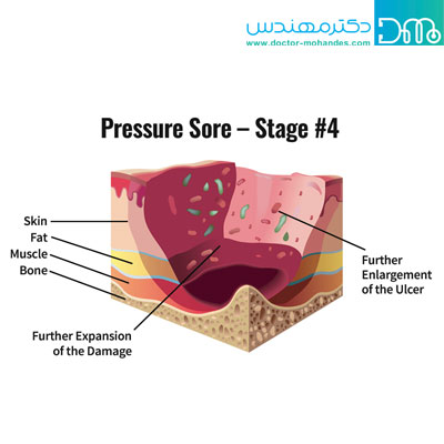 انواع زخم بستر