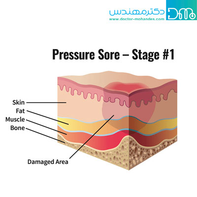 علائم شایع زخم بستر چیست؟