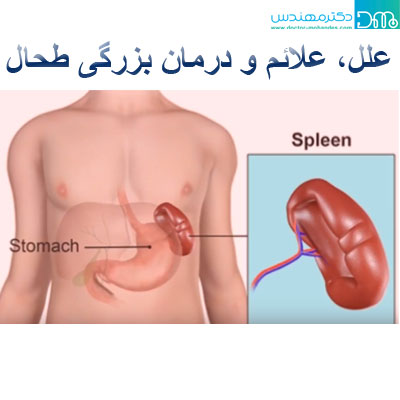 علل، علائم و درمان بزرگی طحال