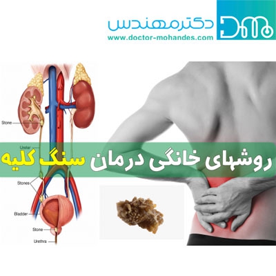 دفع سنگ کلیه بدون نیاز به دارو