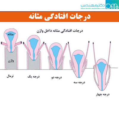 درجات مختلف افتاذگی مثانه