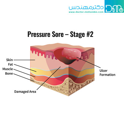 درجات زخم بستر