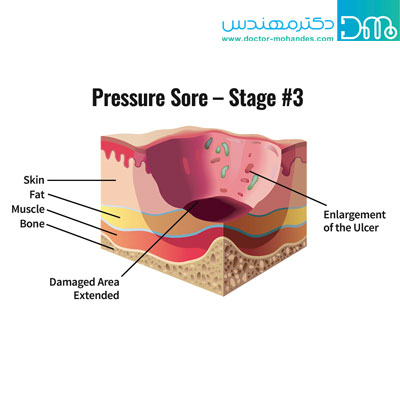 انواع زخم بستر