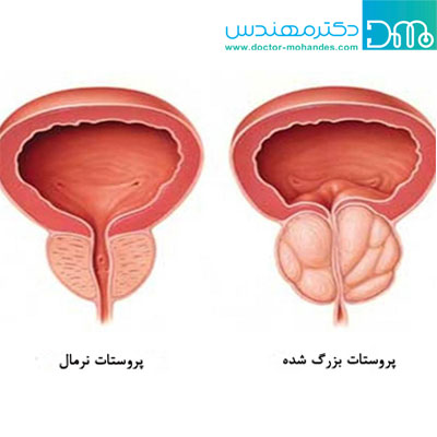 درمان پروستات