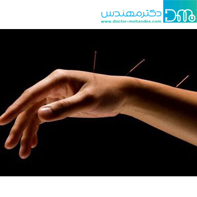 درمان آرتروز مچ دست