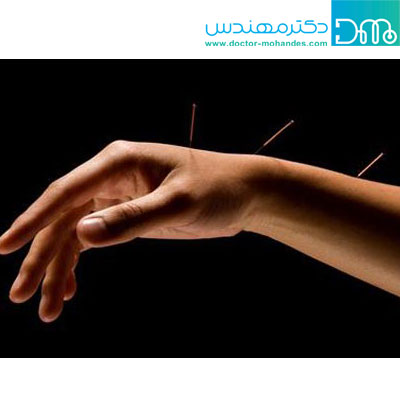 درمان آرتروز مچ دست