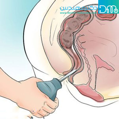 درمان یبوست شدید با تنقیه 
