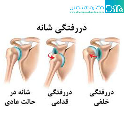 در رفتگی شانه