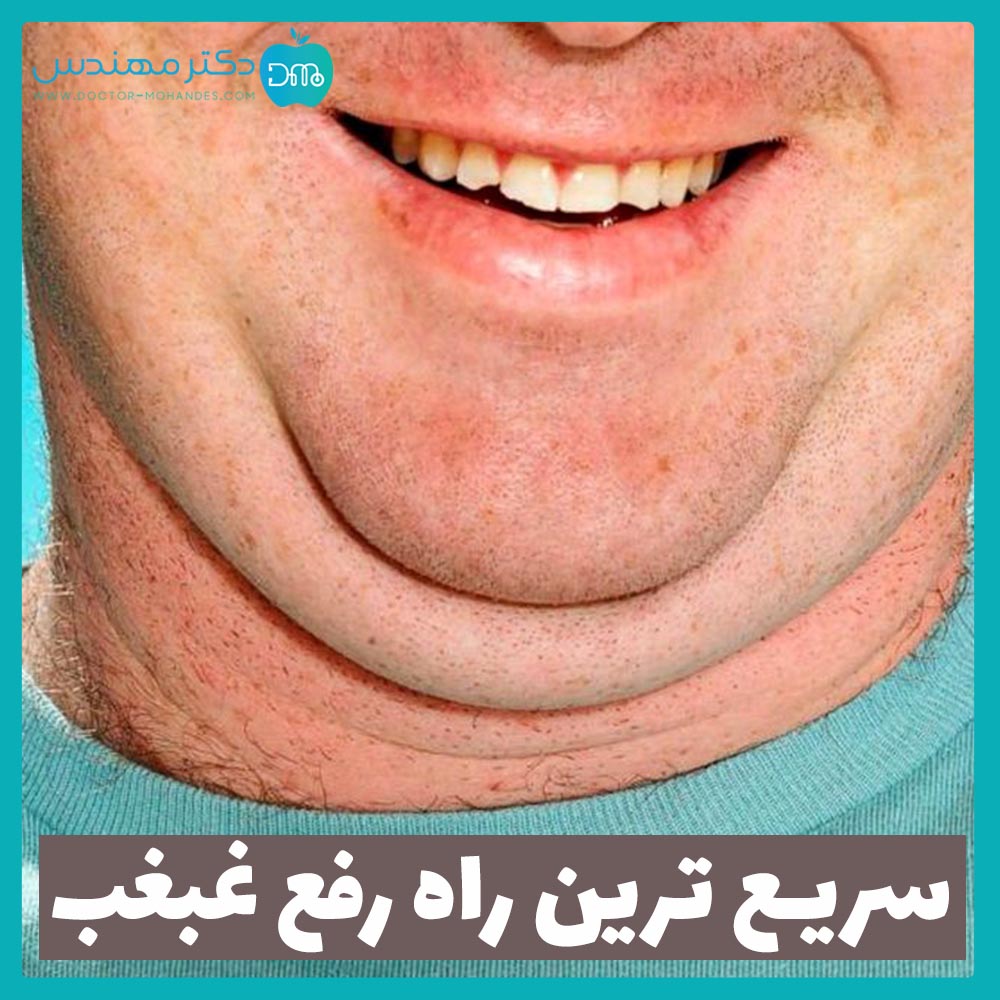 رفع غبغب