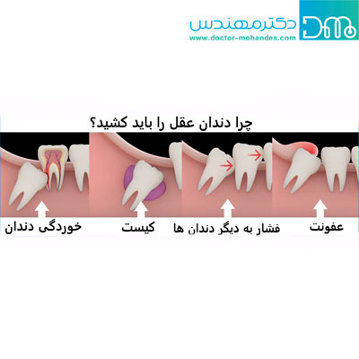 چرا دندان عقل را بايد کشيد؟