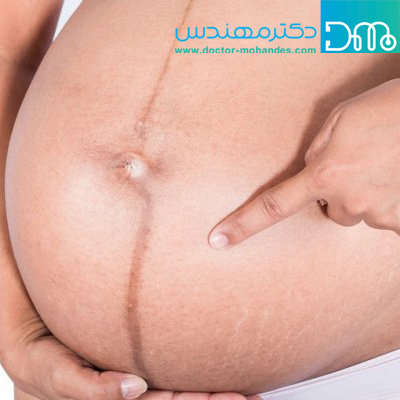 علت تیره شدن پوست در بارداری چیست؟