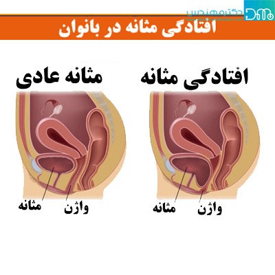 افتادگی مثانه | علت، علائم و درمان