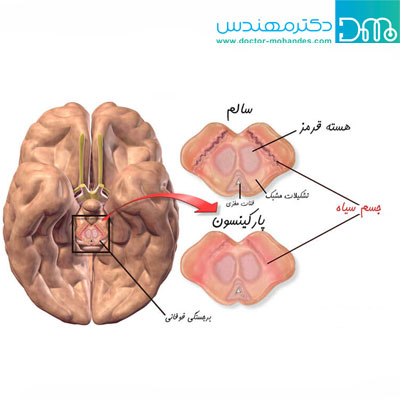 بیماری پارکینسون چیست؟