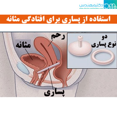 درمان افتادگی مثانه