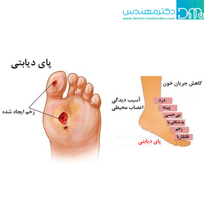 چه چیزی باعث ایجاد زخم پای دیابتی می‌شود؟