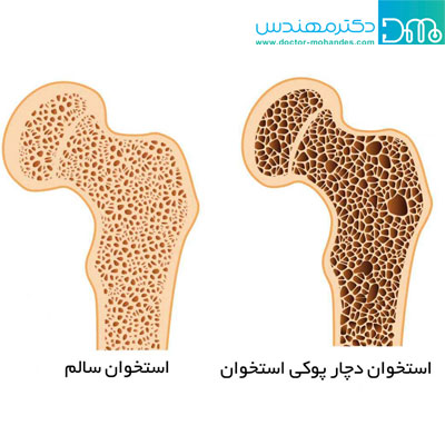 کمبود کلسیم و شکنندگی استخوان ها