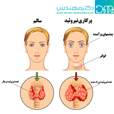  پرکاری تیروئید چیست؟