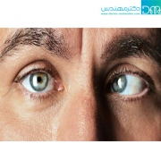 انحراف چشم: علت، علائم، درمان