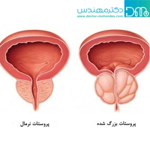 درمان پروستات