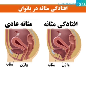 افتادگی مثانه | علت، علائم و درمان