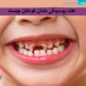 علت پوسیدگی دندان کودکان چیست