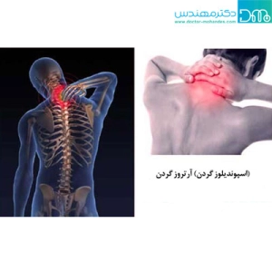 علایم، علل و درمان آرتروز گردن