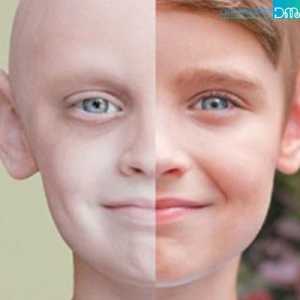 سرطان خون در کودکان