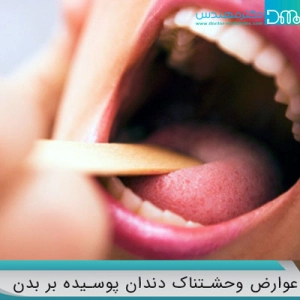 عوارض ریشه پوسیده دندان