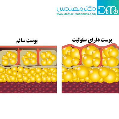 سلولیت چیست؟