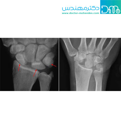 تشخیص آرتروز مچ دست