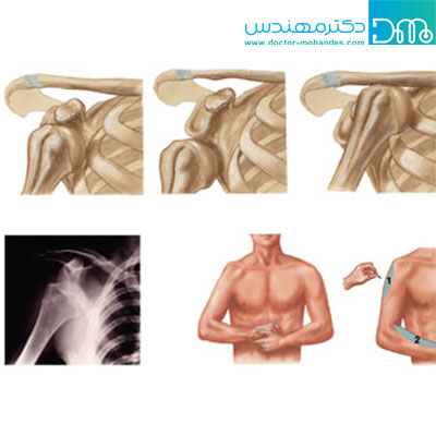 راه های تشخیص دررفتگی