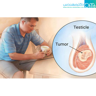 علت درد بیضه چپ و راست چیست؟ 