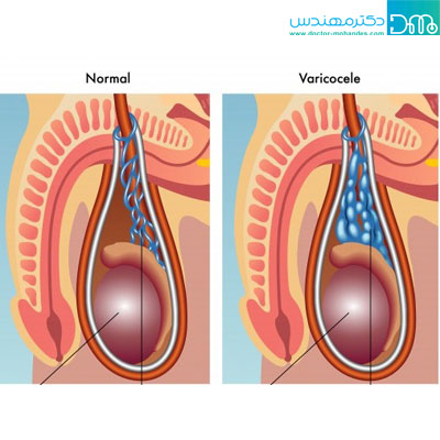 درد بیضه راست نشانه چیست؟