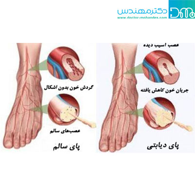 زخم پای دیابتی