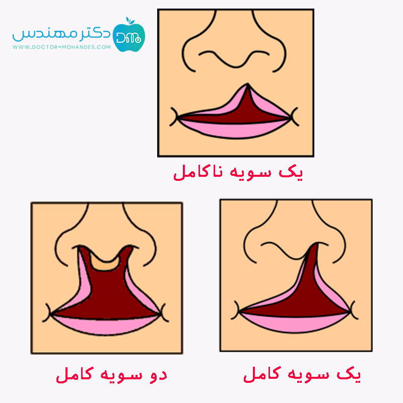 انواع شکاف لب