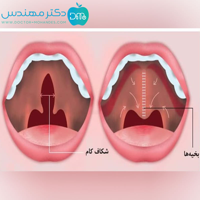 بخیه کام