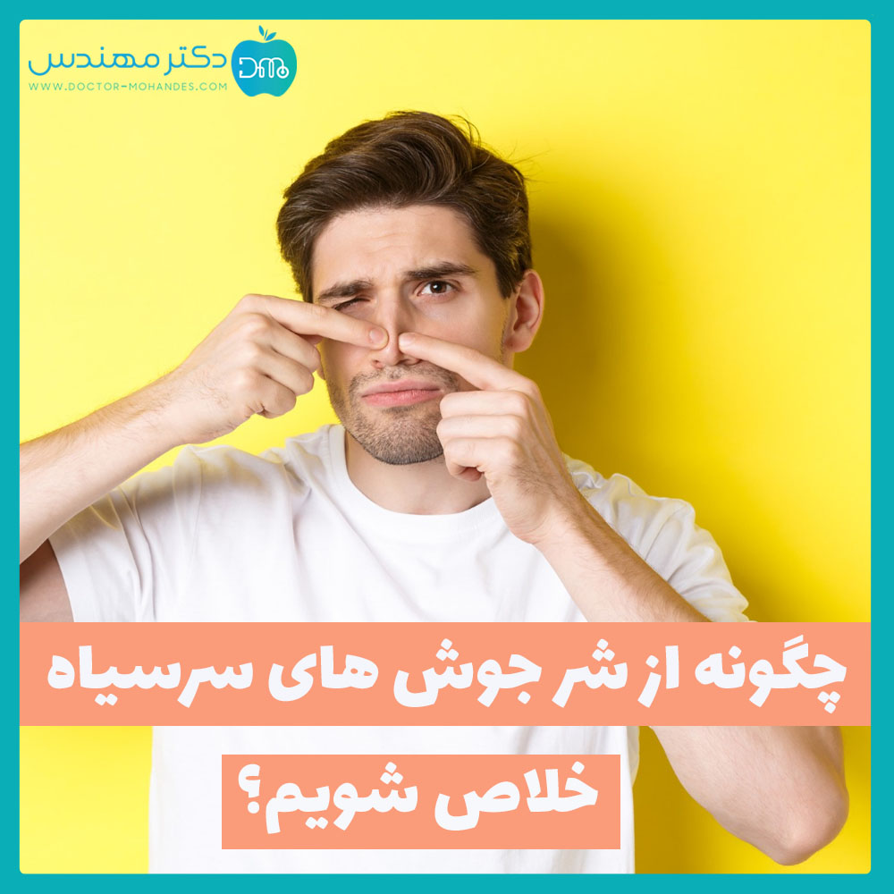 جوش های سر سیاه