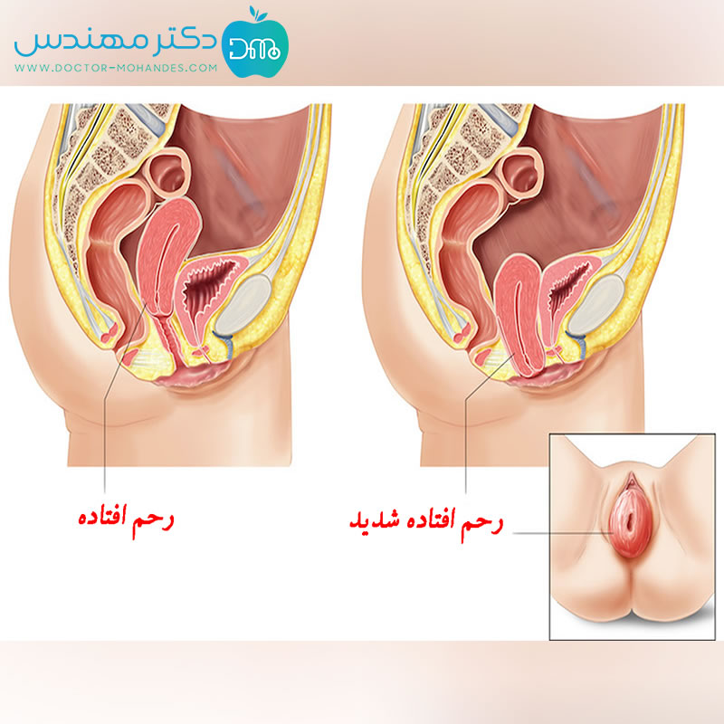 ضدبادارئ 3