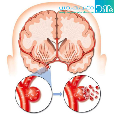 عوارض بعد از سکته مغزی